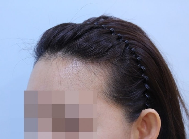 수술전 (3).JPG