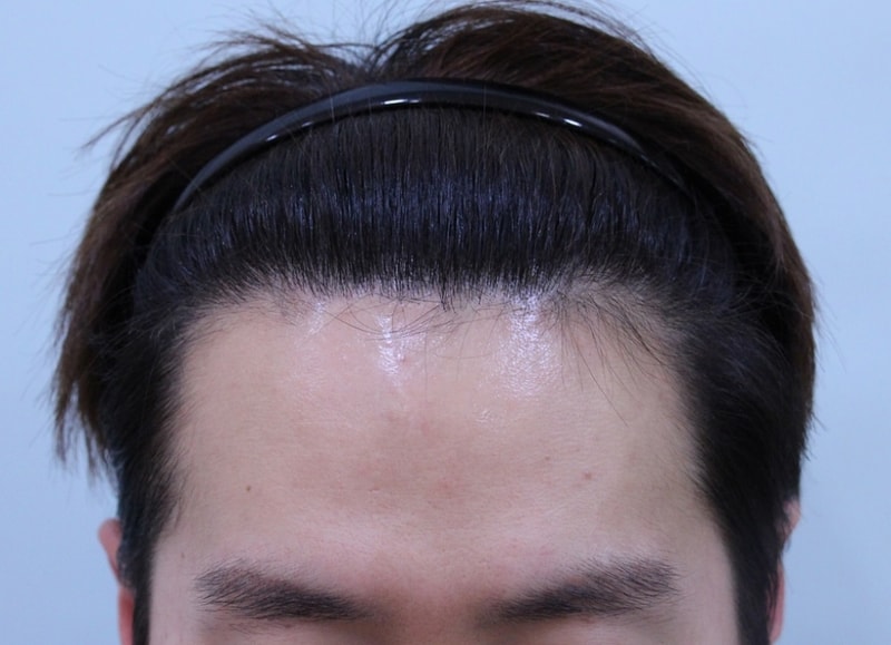 수술후 1년3개월째 (2).jpg