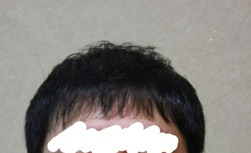 수술1년후 (1).jpg