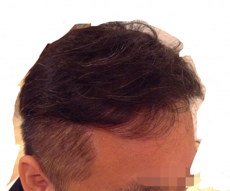 수술 후.jpg