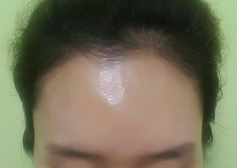 JP에서 M자 헤어라인 6개월차 비절개 2차 후기 올려요