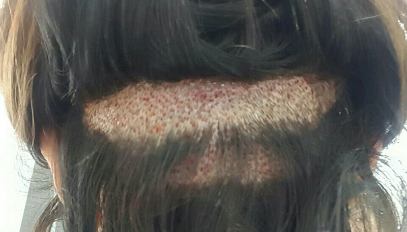 수술 후 1일째3.JPG