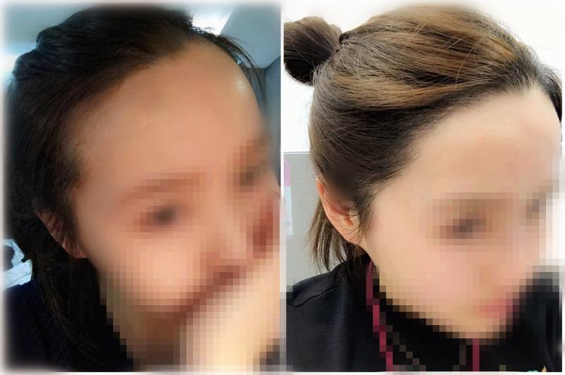 두번째 후기 - JP모발이식센터 헤어라인교정 절개 2500모 1년 1개월 지났어용