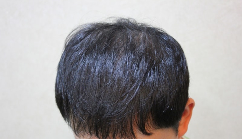 수술1년후 (2).jpg