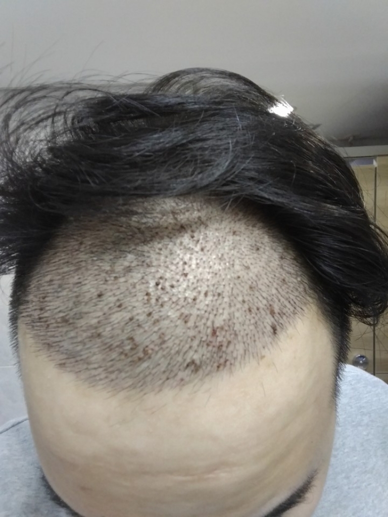 10일 딱지제거.jpg