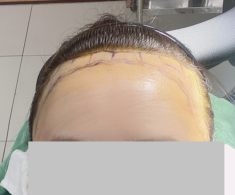 2수술당일2.png
