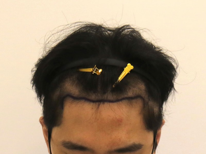 부산 모발이식 슬릿 방식 맘모스 M자 1년 경과