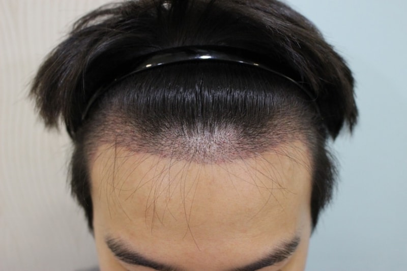 수술 10일 후 (1).jpg