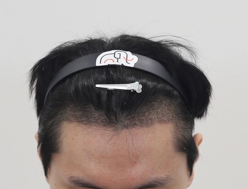 2주 경과.jpg