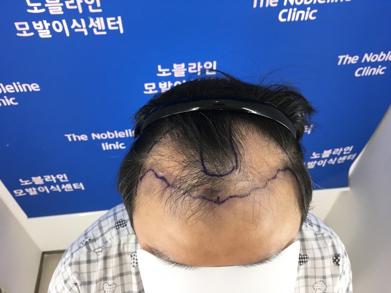 M자형 8250모 대량이식 10일 후기
