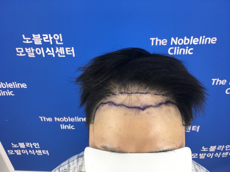 I had another surgery on Novline
