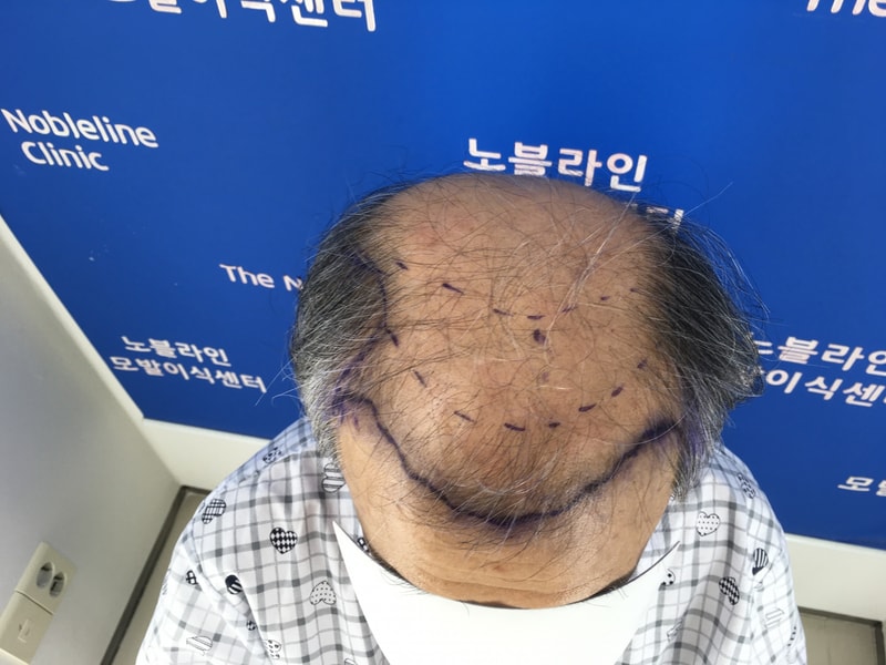 70代です。 この歳で何の植毛かということもありますが、息子が勇気をくれて手術しました。