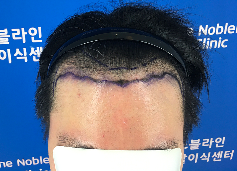 빽빽해지고 싶어서 모발이식 했어요.