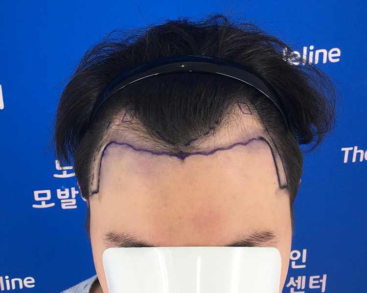 7개월 후기! 모발이식 후 일상이 참 편안합니다.