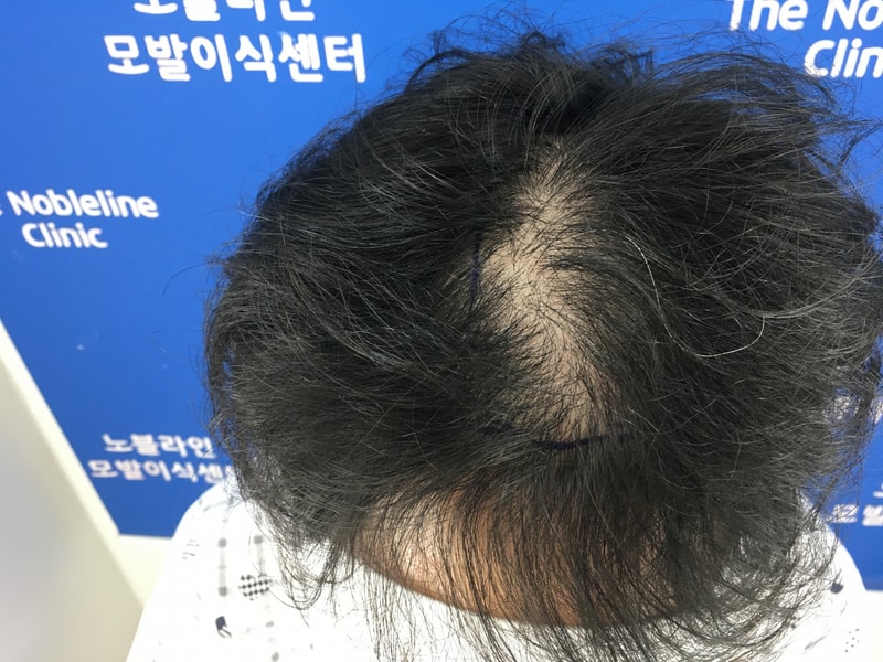 30대 초반, 정수리 탈모 모발이식 4개월 입니다.