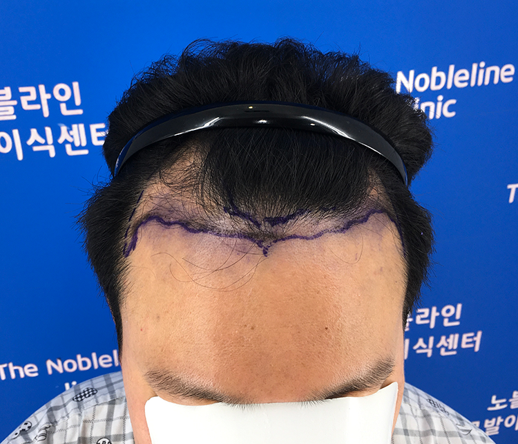 100일차 비대칭 엠자탈모 모발이식 후기