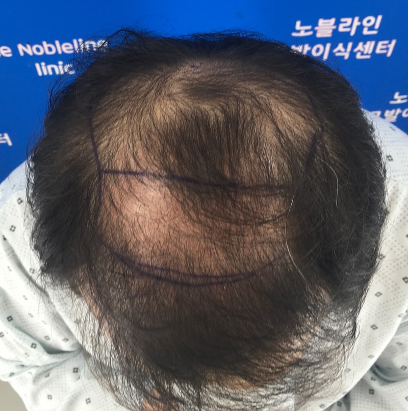 정수리 암흑기 지나는 중 입니다.