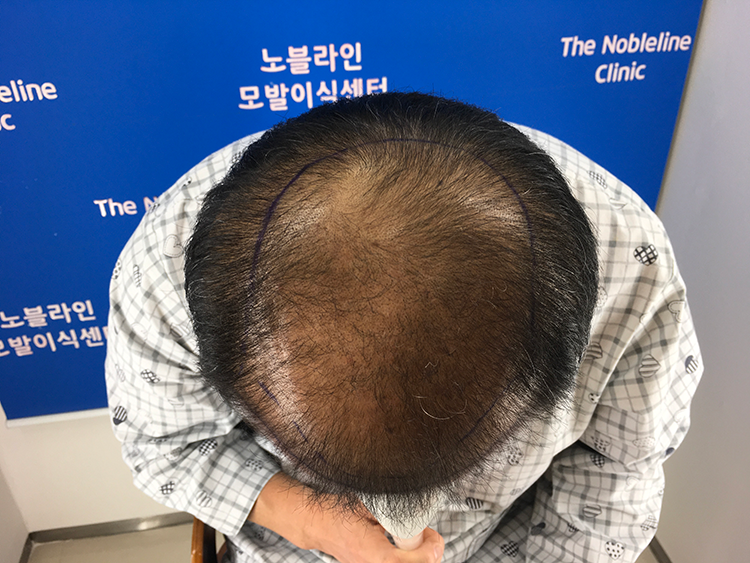 It's a thin hair that says surgery is difficult. I finally had a hair transplant.