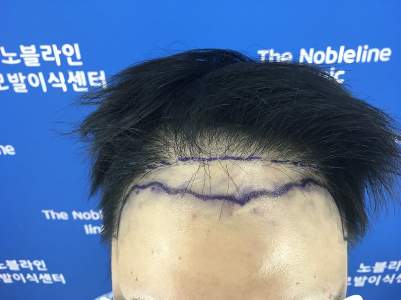 Three months after the failure of Gangnam Medical Center, 4038 hair transplants are saved in the dark period!