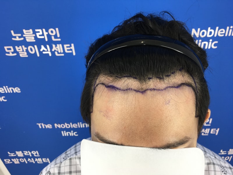 엠자+헤어라인내림+구렛나루 모발이식 했습니다.