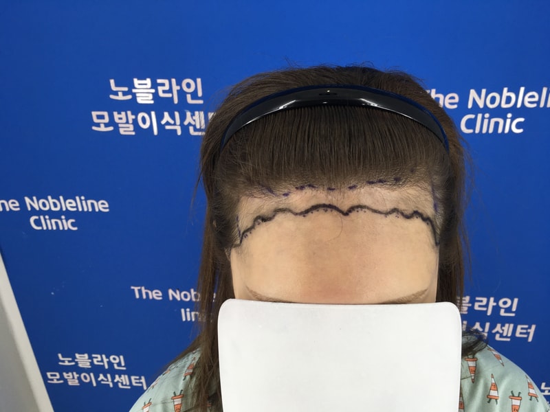 헤어라인 이식 했어요.