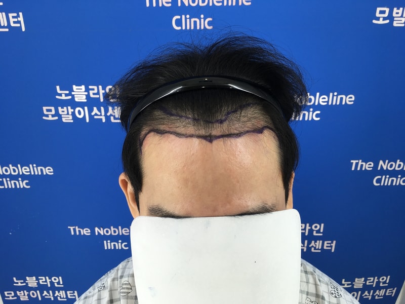 几帳面な比較の上、選択したThe Nobleline Center for Alopecia Care