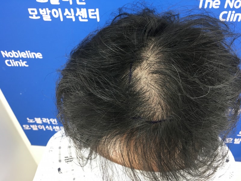 정수리 가르마 부위 모발이식