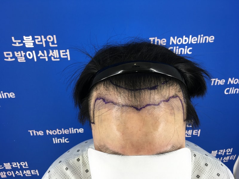 노블라인 백현욱 원장님 수술 1달 후기