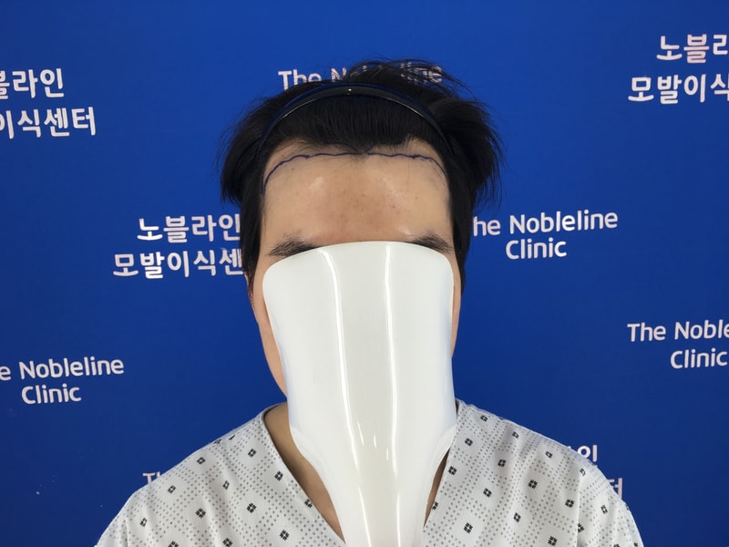 엠자 모발이식 수술 3개월+ 후기