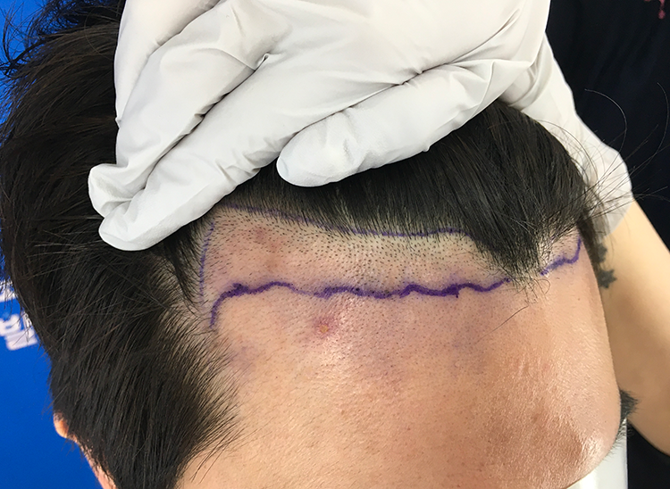 Small M-shaped forehead 986 hair follicle 8 months graduation review