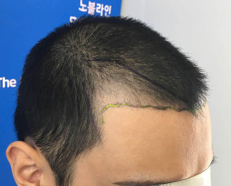6개월째 티 하나도 안 나요.