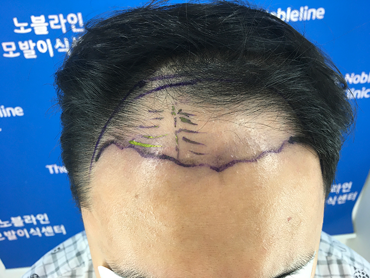 모발이식 받았습니다.
