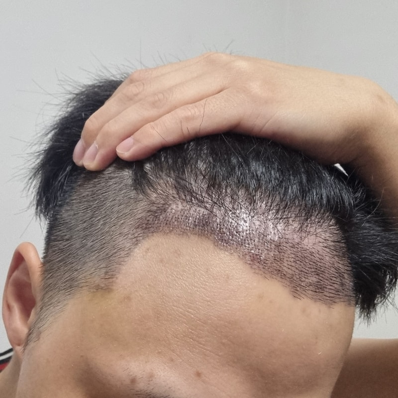 I'm posting a review on the 10th day of reoperation