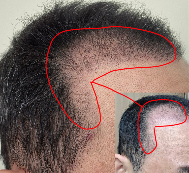 빠졌던 머리가 다시 올라옵니다. 기분 좋습니다!