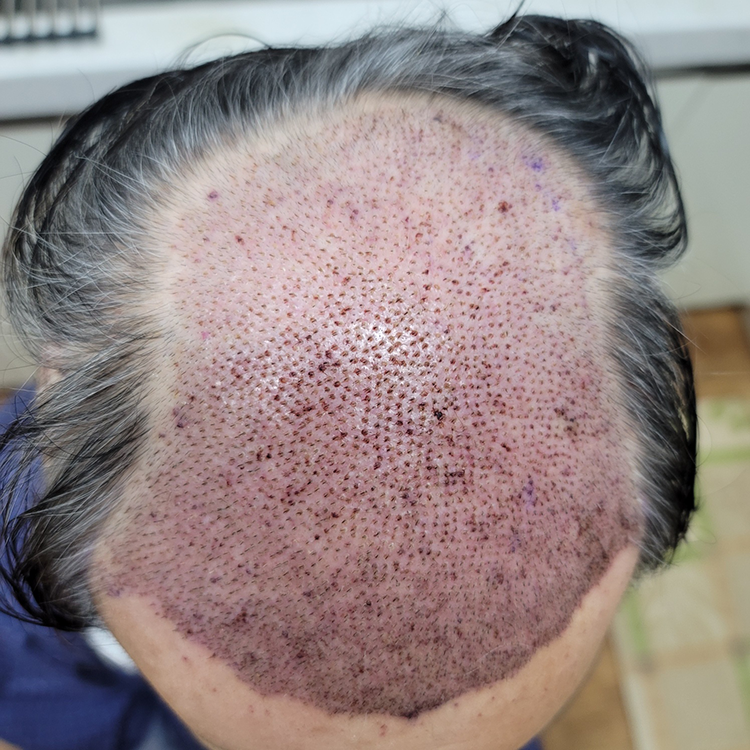 심장수술 후에 모발이식받은 후기 입니다.