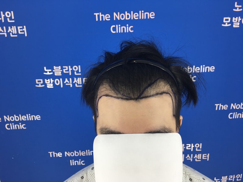 5500모 비절개모발이식 제가 해보니 진짜 다릅니다.