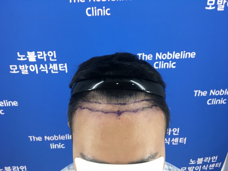 재수술 8개월차
