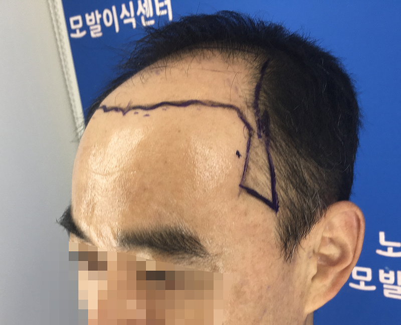 수술전4.png