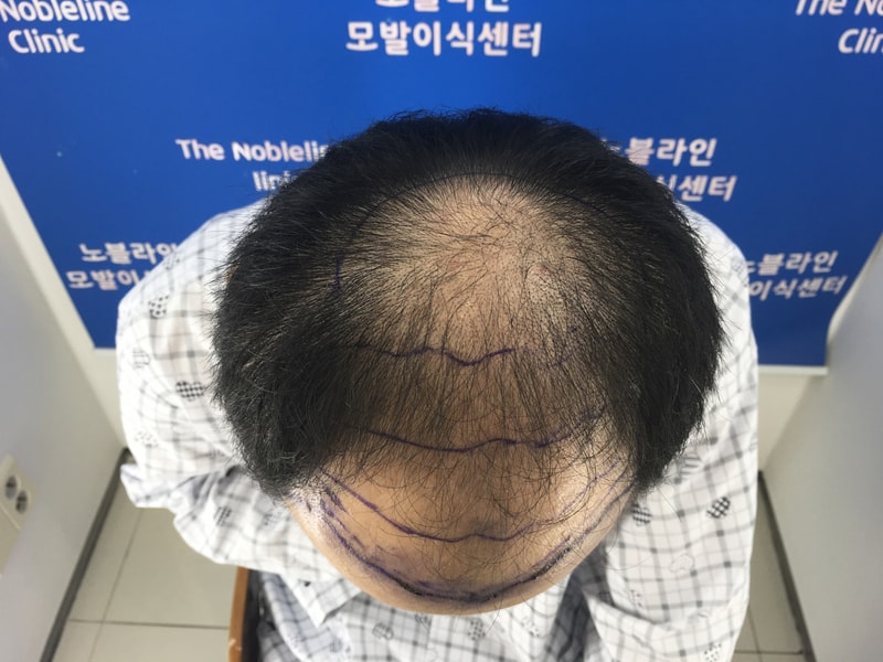 대량 모발이식 3개월 되었습니다!