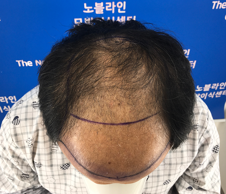 27년차 가발탈출 6개월 후기