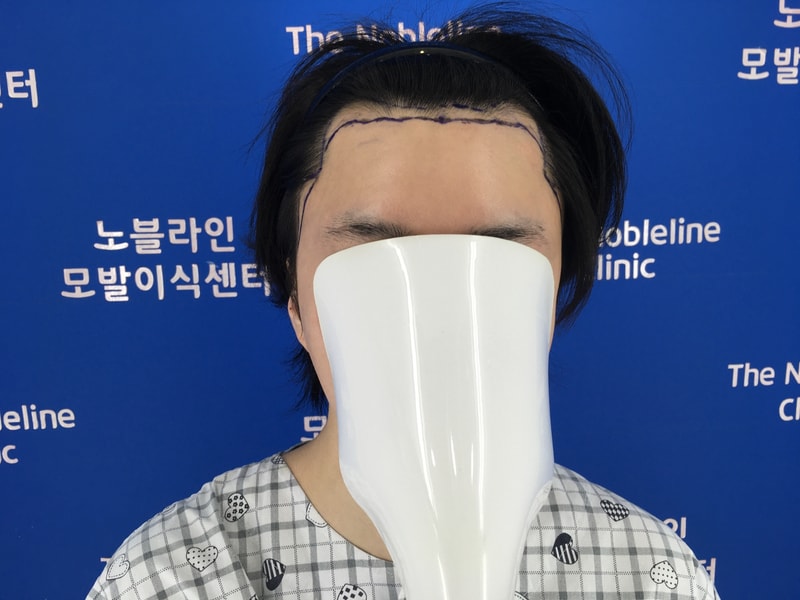 졸업했습니다. 최고의 모발이식병원 노블라인을 추천 합니다.