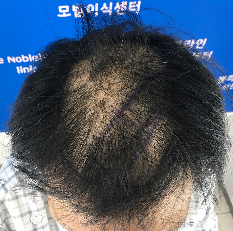 1차수술 실패 후 대량모발이식 9040모 5~6개월 입니다. 드디어 성공각 입니다!
