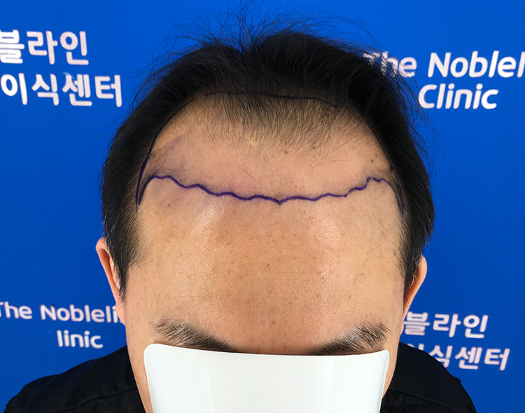 만모이식 두달째 후기