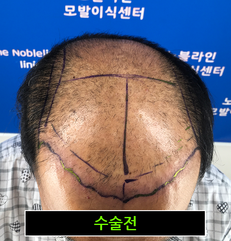 모발이식 1년, 올 여름 가발 벗고 사니 너무 너~무 좋습니다!