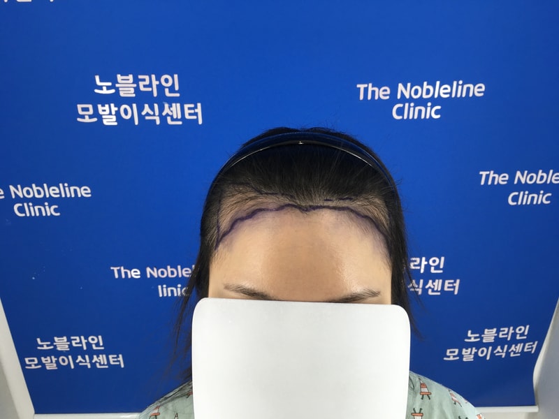 친구가 수술하고 넘 잘 돼서 저도 했어요.