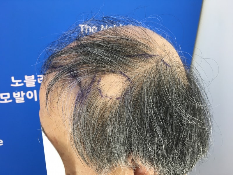 70代です。 植毛してから3ヶ月になりました。