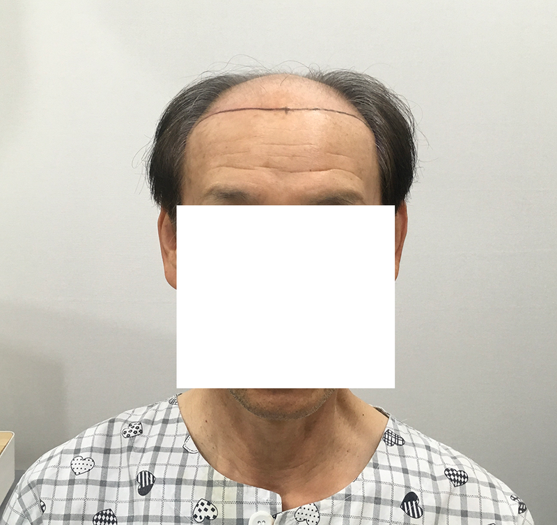 백현욱 원장님 8039모 대량모발이식 8개월 후기