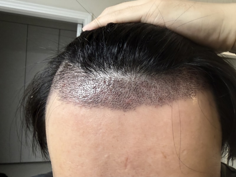 正確な説明、自然なデザインの方向性、安定的な回復過程のために選択したThe Nobleline Center for Alopecia Care