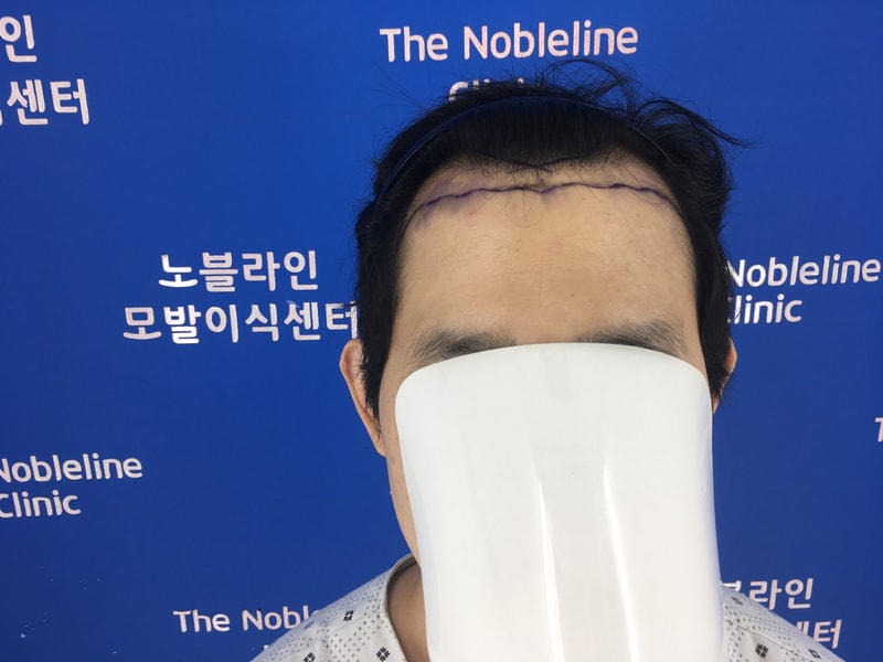 M-shape + top repair O-shape changed after 8 months