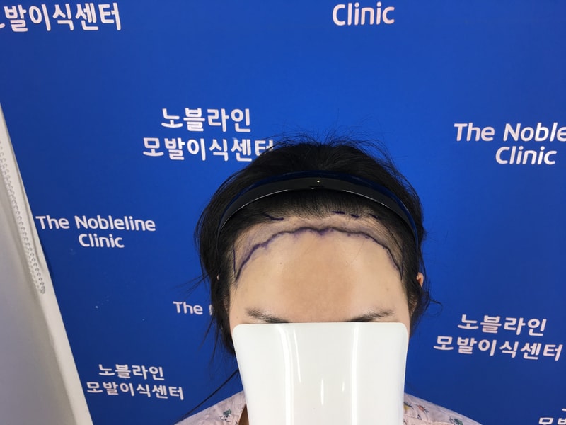 SMP 원장님한테 추천 받고 모발이식 했어요.